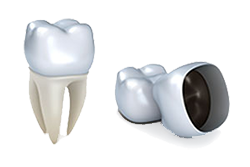 Dental Crown | Ideal Smile Dentistry | Nahideh Shojaei DDS PC | Madera, CA 93637