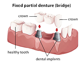 Dental bridges | Ideal Smile Dentistry | Nahideh Shojaei DDS PC | Madera, CA 93637