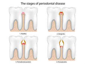 Gum Disease Treatment | Ideal Smile Dentistry | Nahideh Shojaei DDS PC | Madera, CA 93637